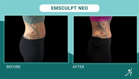 emsculpt neo oakdale|Our Story .